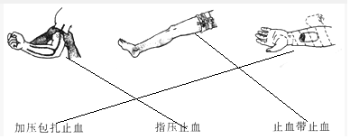 屈肢加垫止血法:当前臂或小腿出血时,可在肘窝,膝窝内放以纱布垫,棉花