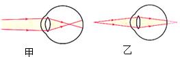 甲需配戴的眼镜是凸透镜 b.乙需配戴的眼镜是凹透镜 c.甲需配