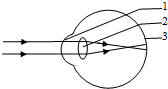 图是近视眼成像示意图,据图回答: 近视眼是由于标号[2] 晶状体 晶状