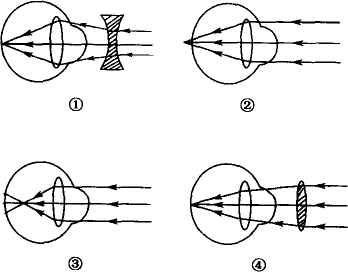 如图所示④四幅图分别表示来自远方物体的光经过远视眼近视眼