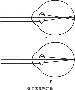 下图是眼球成像的模式图.请根据图回答下列问题. (1) 图是正常的眼睛.