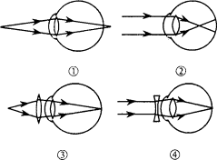 眼的成像原理有的给出了近视眼或远视眼的矫正方法下列判断正确的是